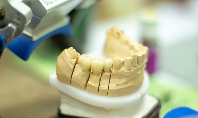 Tout ce que vous devez savoir sur l’implantologie dentaire