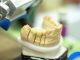 Tout ce que vous devez savoir sur l’implantologie dentaire